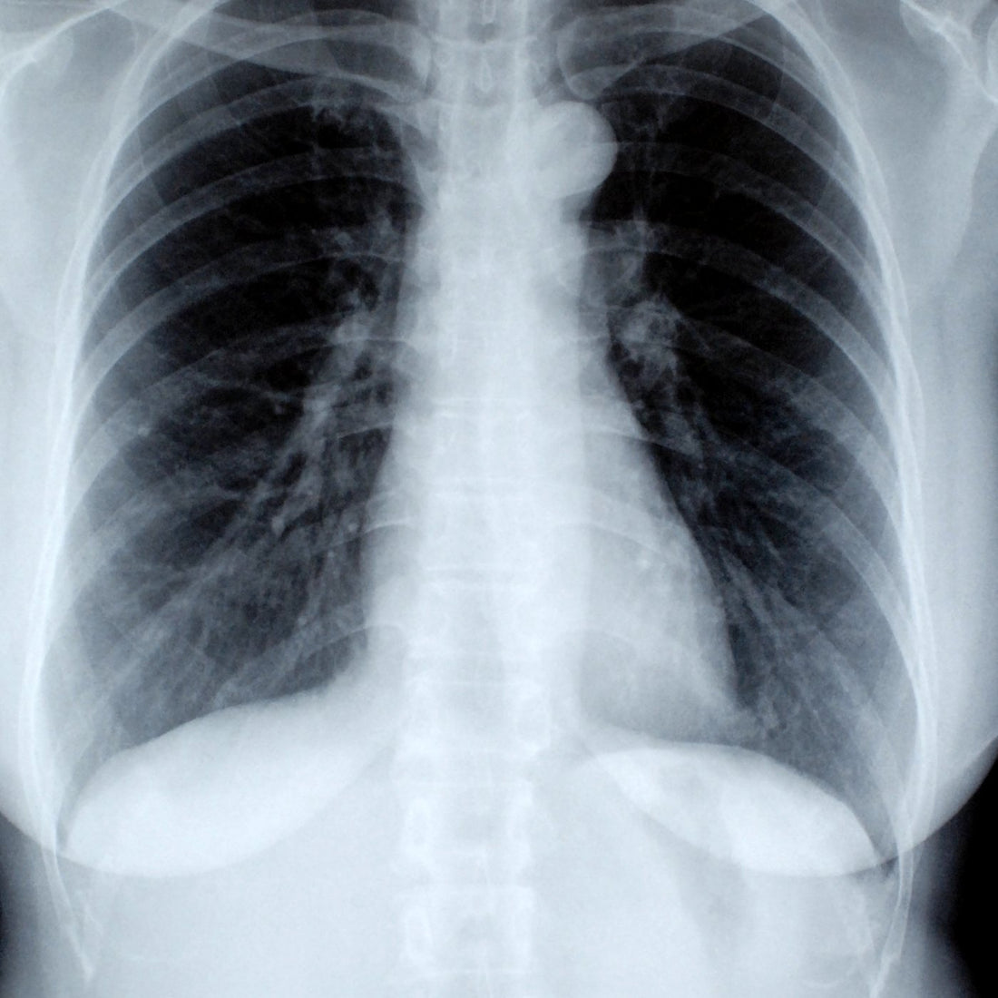 Chest X-ray radiograph on a viewing screen