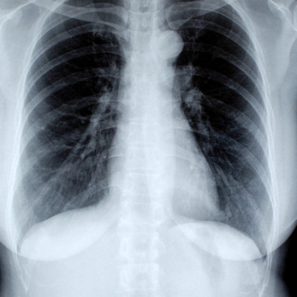 Chest X-ray radiograph on a viewing screen